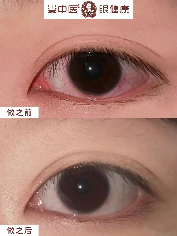 娄中医眼健康提醒您：千万不要大意！早上起床“眼屎”增多，当心是这些眼病！